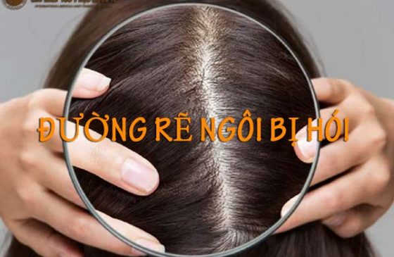 đường rẽ ngôi bị hói