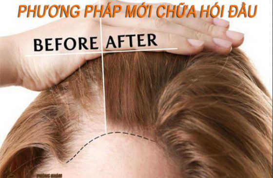 phương pháp mới chữa hói đầu