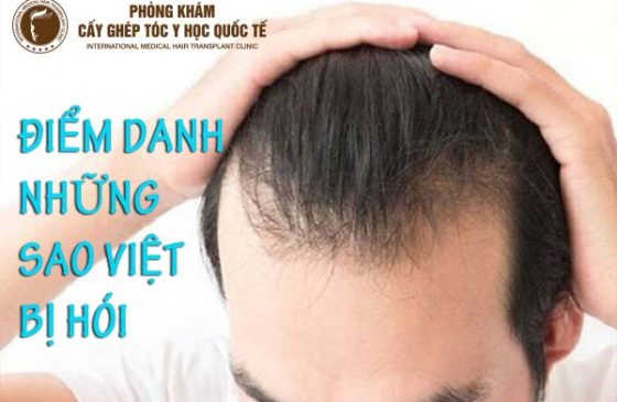 sao việt bị hói
