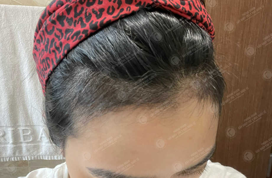Trịnh Thùy Linh - Cấy tóc tự thân 12
