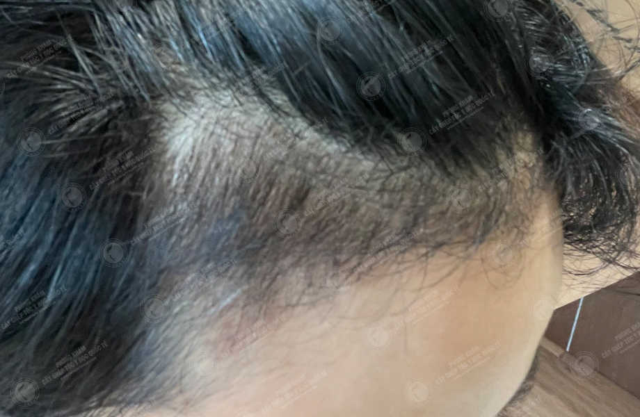Trịnh Thùy Linh - Cấy tóc tự thân 13