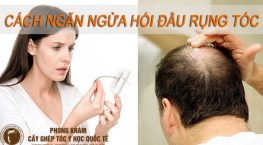 cách ngăn ngừa hói đầu