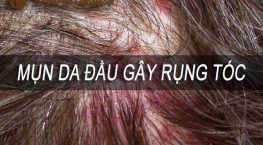 mụn da đầu gây rụng tóc