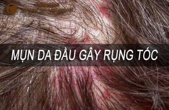 mụn da đầu gây rụng tóc