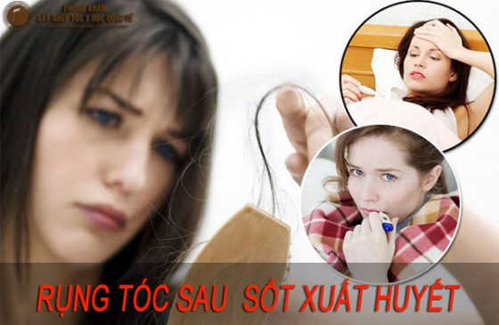rụng tóc sau sốt xuất huyết