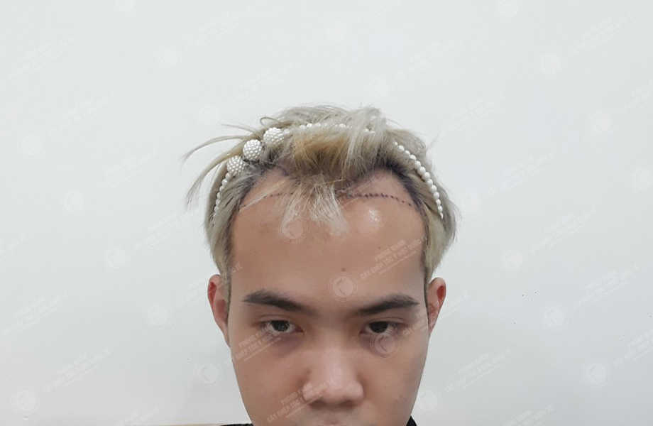 Trần Minh Quang - Cấy tóc đường chữ M 2