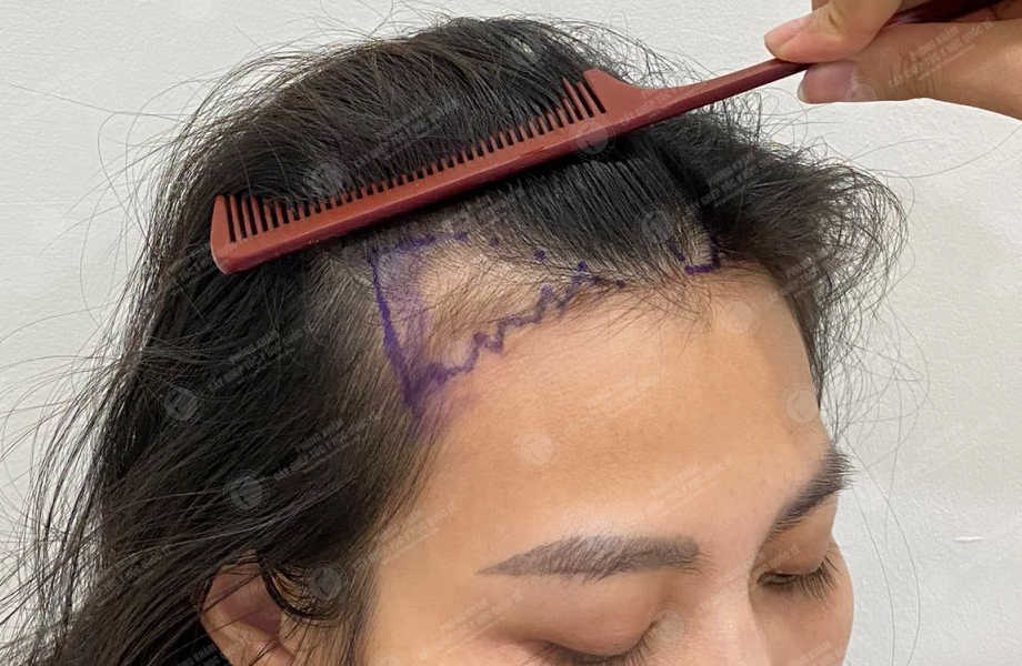 Lê Hồng Loan - Cấy tóc đường chữ M 2
