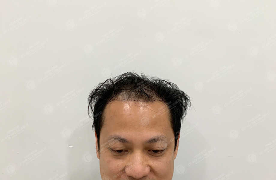 Nguyễn Tùng Dương - Cấy tóc trên sẹo 2