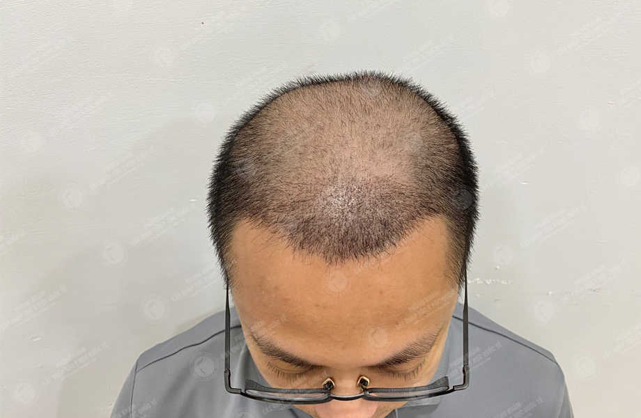 Nguyễn Tùng Dương - Cấy tóc trên sẹo 13