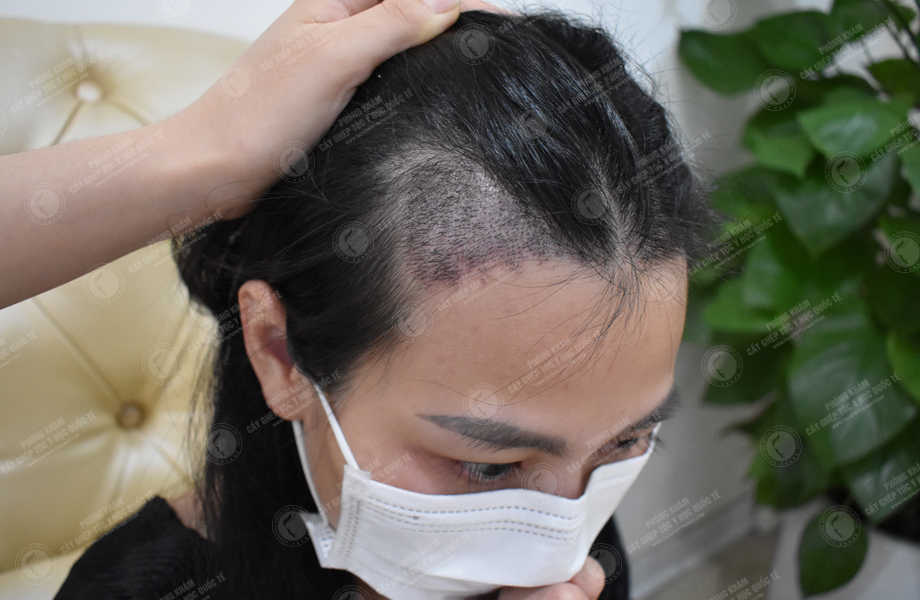 Lê Hồng Loan - Cấy tóc đường chữ M 13