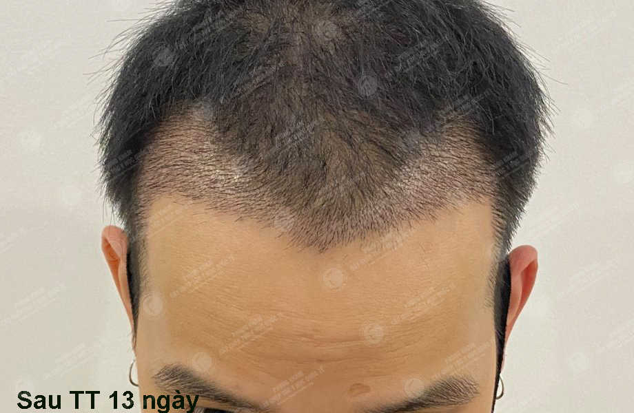 Vũ Văn Thanh - Cấy tóc đường chữ M 9