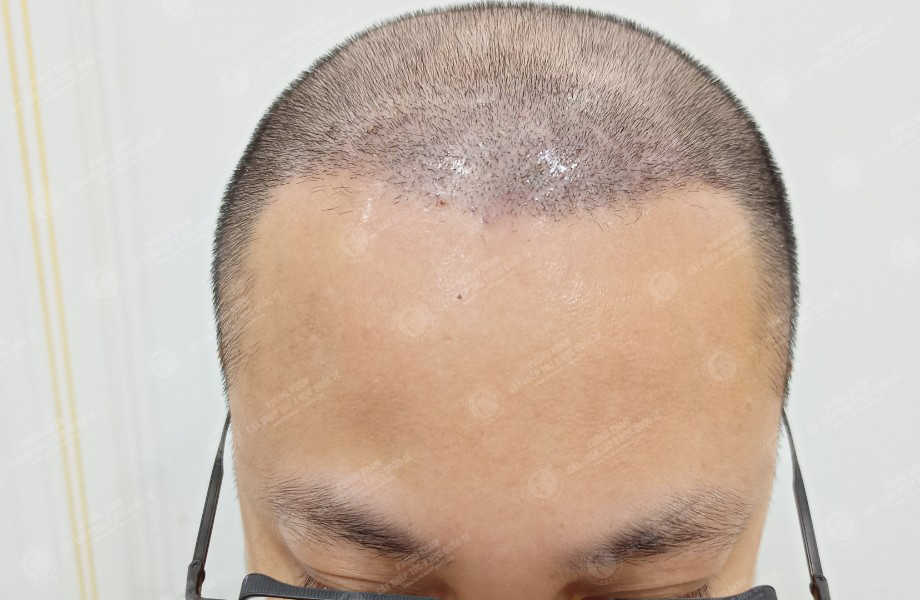 Nguyễn Tùng Dương - Cấy tóc trên sẹo 10