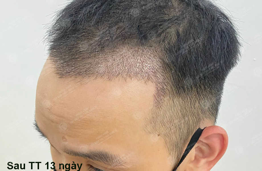 Vũ Văn Thanh - Cấy tóc đường chữ M 10