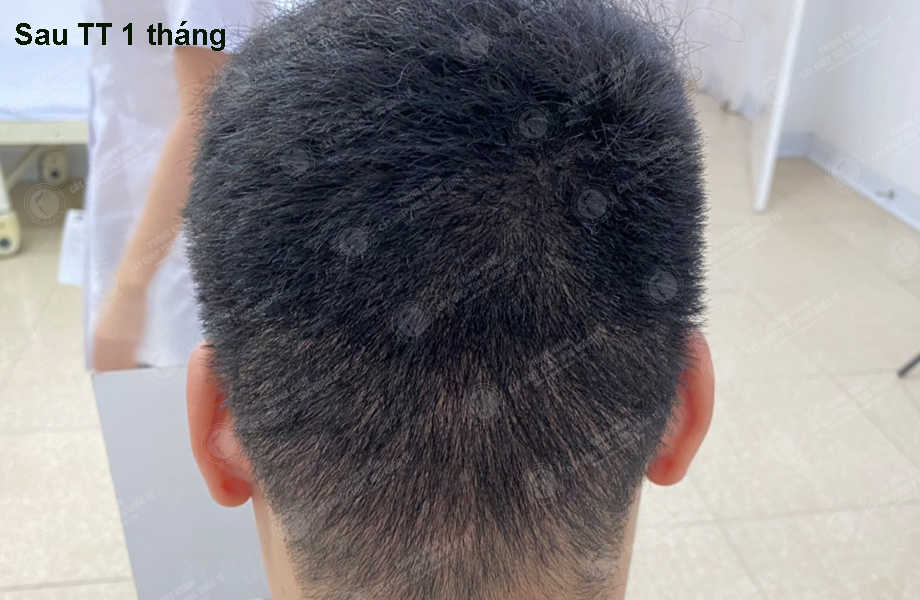 Nguyễn Hữu Nam - Cấy tóc đường chữ M 11