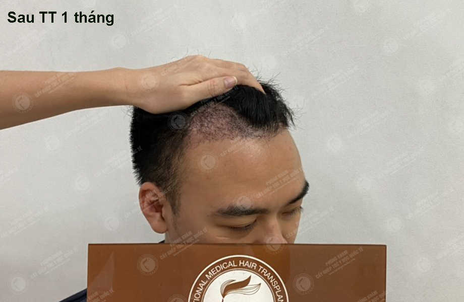 Nguyễn Hữu Nam - Cấy tóc đường chữ M 12