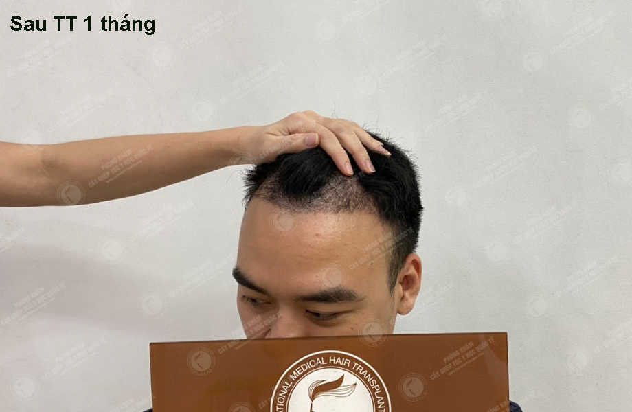 Nguyễn Hữu Nam - Cấy tóc đường chữ M 9