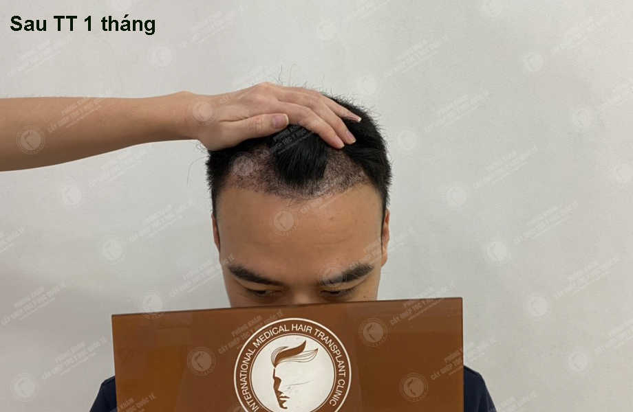 Nguyễn Hữu Nam - Cấy tóc đường chữ M 10
