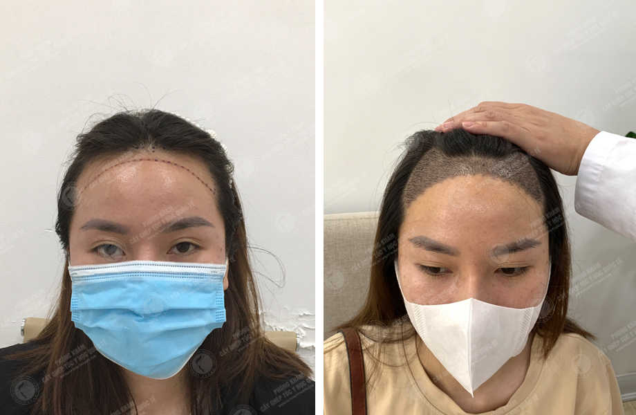  Phan Thu Tuyết - Điều chỉnh đường chân tóc 1