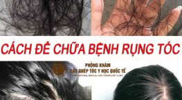 cách để chữa bệnh rụng tóc