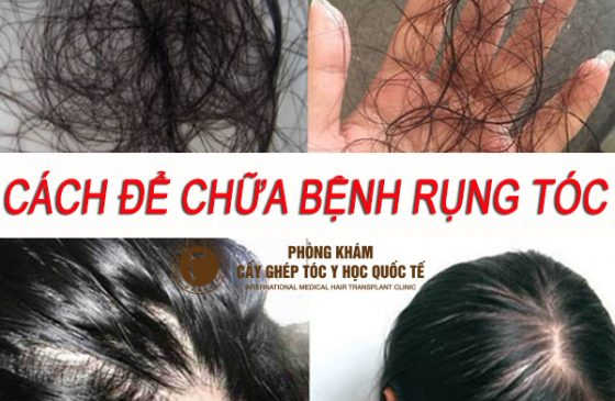 cách để chữa bệnh rụng tóc