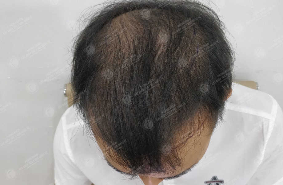 Nguyễn Đức Dương - Cấy tóc tự thân 2