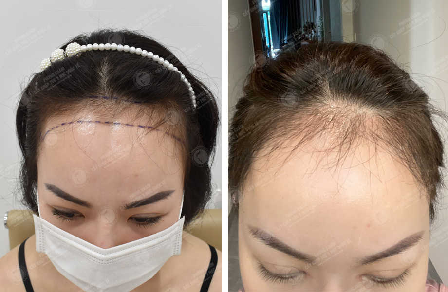  Nguyễn Thu Loan - Cấy tóc tự thân 1
