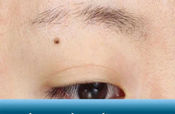 lông mày đứt đoạn