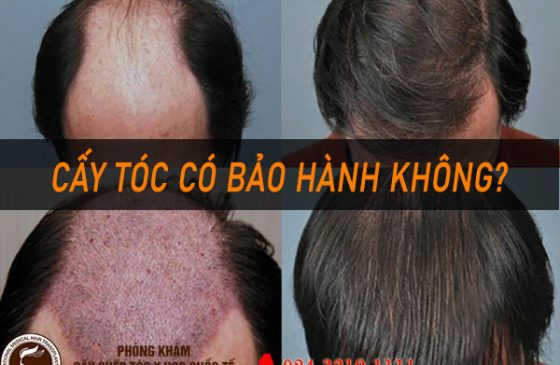 cấy tóc có bảo hành không