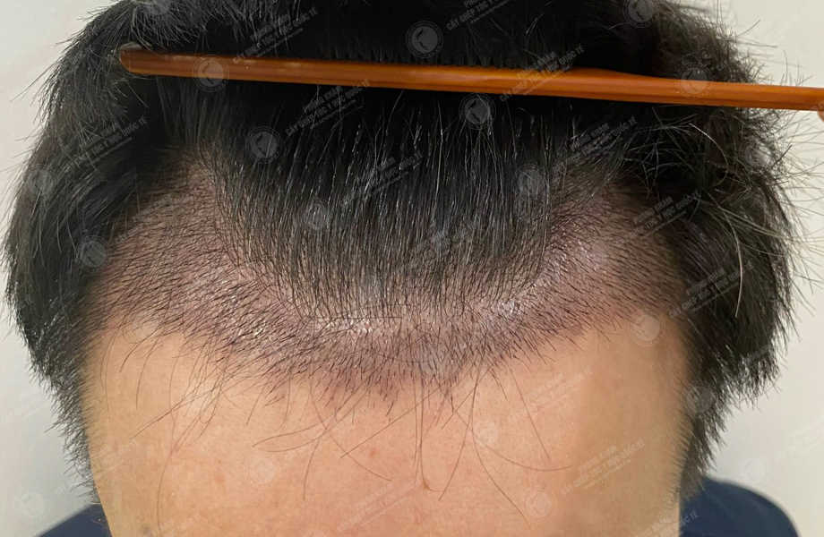 Lại Văn Ngọc - Cấy tóc đường chữ M 10