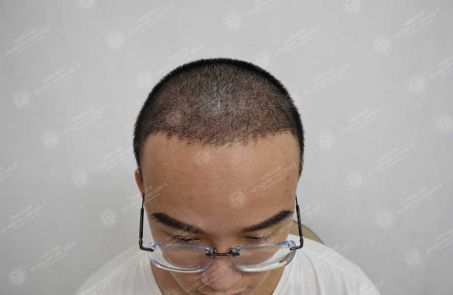 Trần Văn Tài - Cấy tóc đường chữ M 13