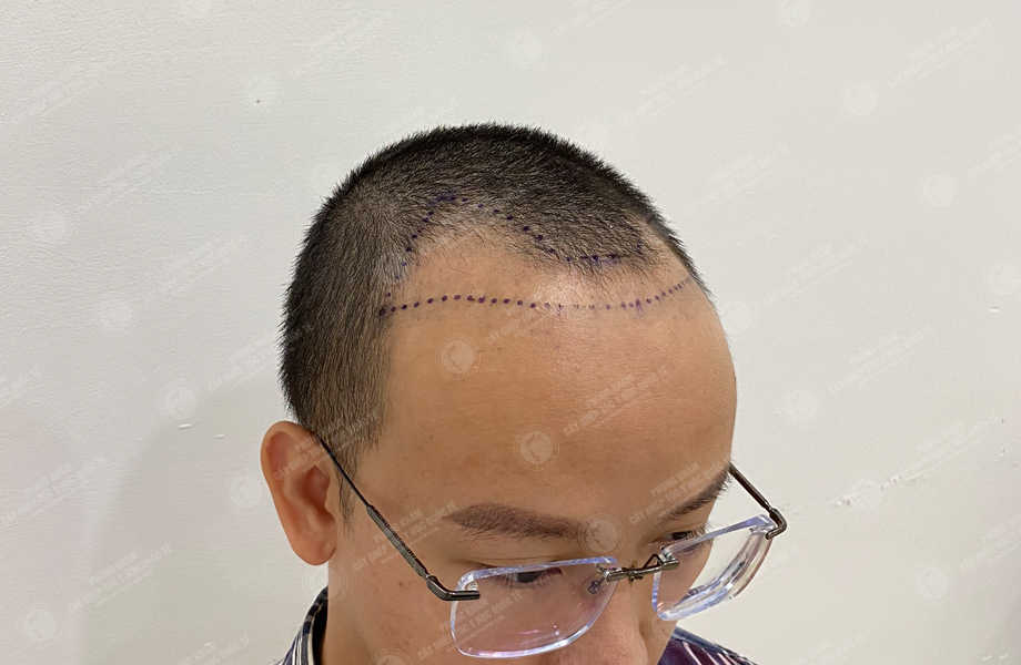 Trần Văn Tài - Cấy tóc đường chữ M 4