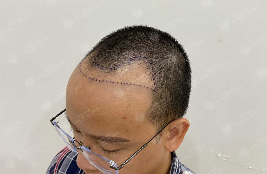Trần Văn Tài - Cấy tóc đường chữ M 5