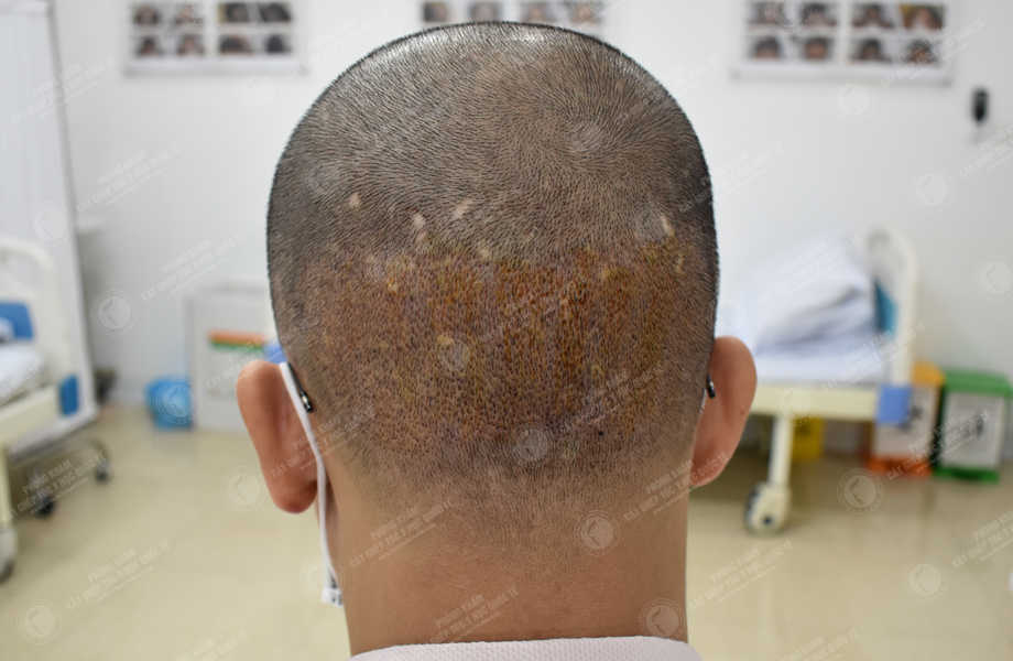 Trần Văn Tài - Cấy tóc đường chữ M 9