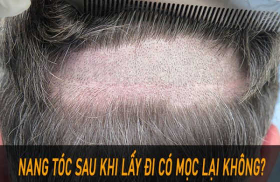 nang tóc sau khi lấy đi có mọc lại không