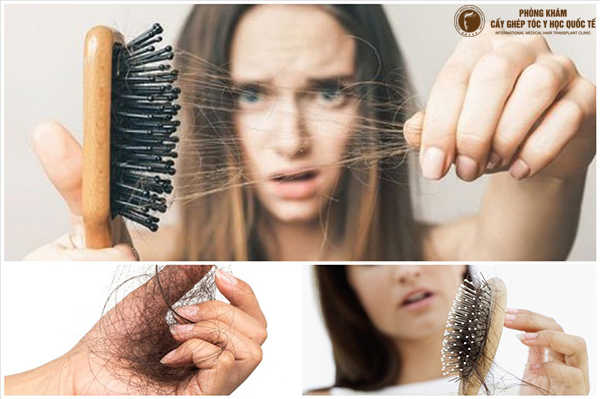 Nguyên nhân gây rụng tóc ở phụ nữ sau 30 tuổi