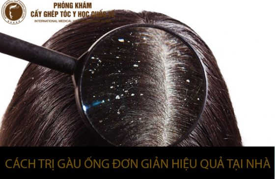 cách trị gàu ống đơn giản tại nhà