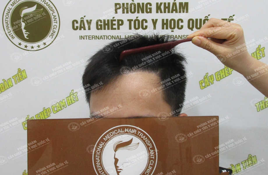 Nguyễn Huy Hoàng - Cấy tóc đường chữ M 8