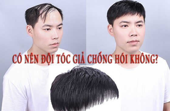 Có nên đội tóc giả chống hói không