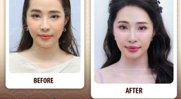 cấy đường chân tóc trán là gì, cấy đường chân tóc trán, cấy tóc cho trán cao, cấy tóc trán chữ m, cấy tóc trán cao,