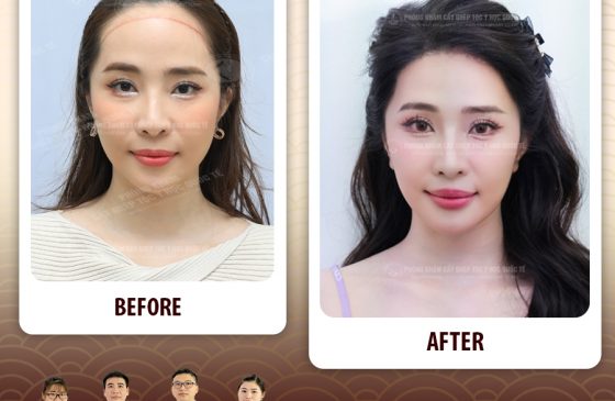 cấy đường chân tóc trán là gì, cấy đường chân tóc trán, cấy tóc cho trán cao, cấy tóc trán chữ m, cấy tóc trán cao,