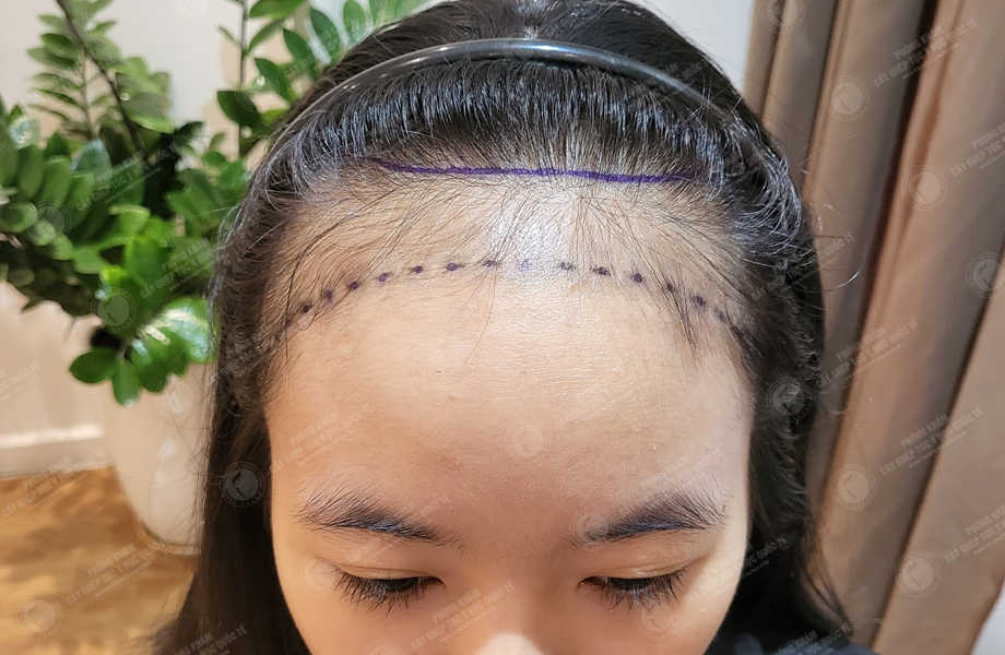 Trần Hoài Phương - Cấy tóc tự thân 2