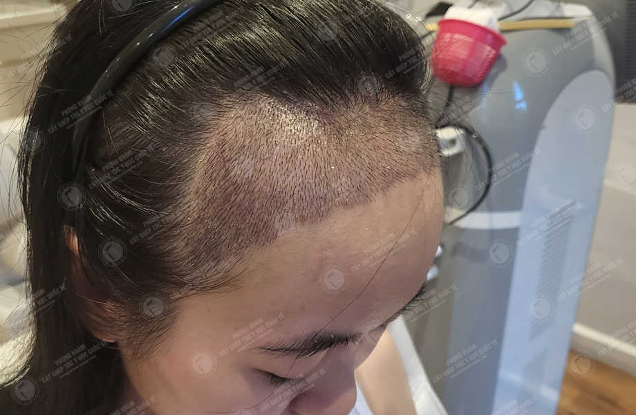 Trần Hoài Phương - Cấy tóc tự thân 12