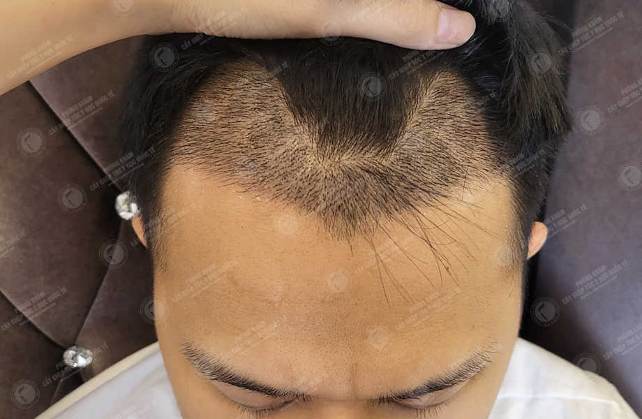 Lý Tuấn Kiệt - Cấy tóc đường chữ M 13