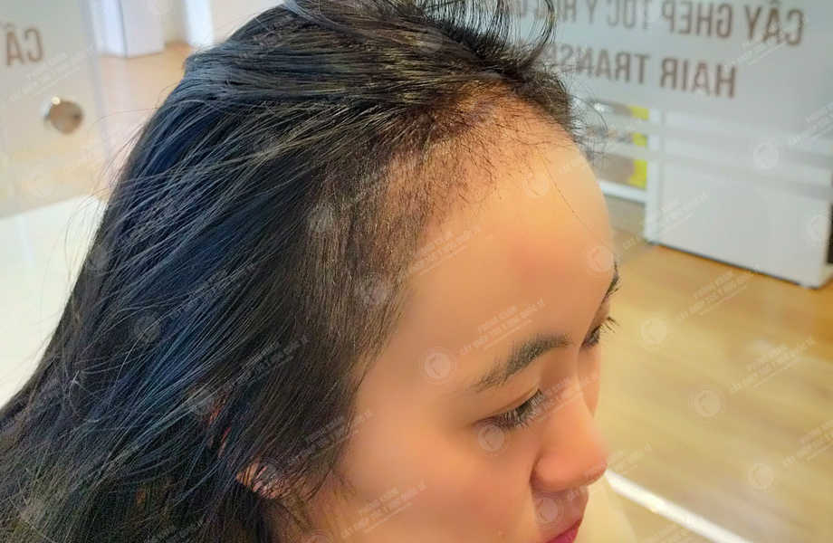 Trần Hoài Phương - Cấy tóc tự thân 13