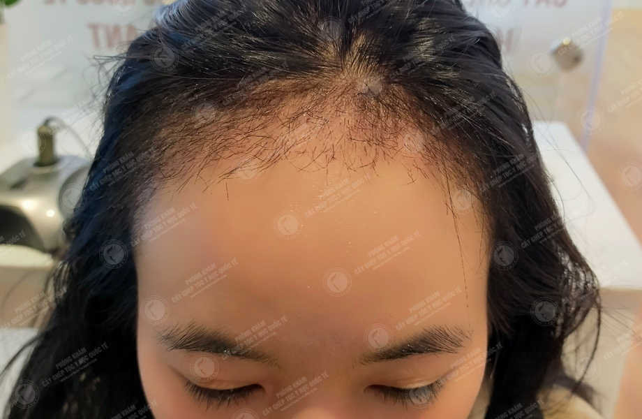 Trần Hoài Phương - Cấy tóc tự thân 15