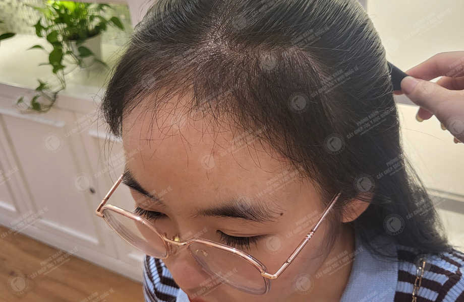 Trần Hoài Phương - Cấy tóc tự thân 16