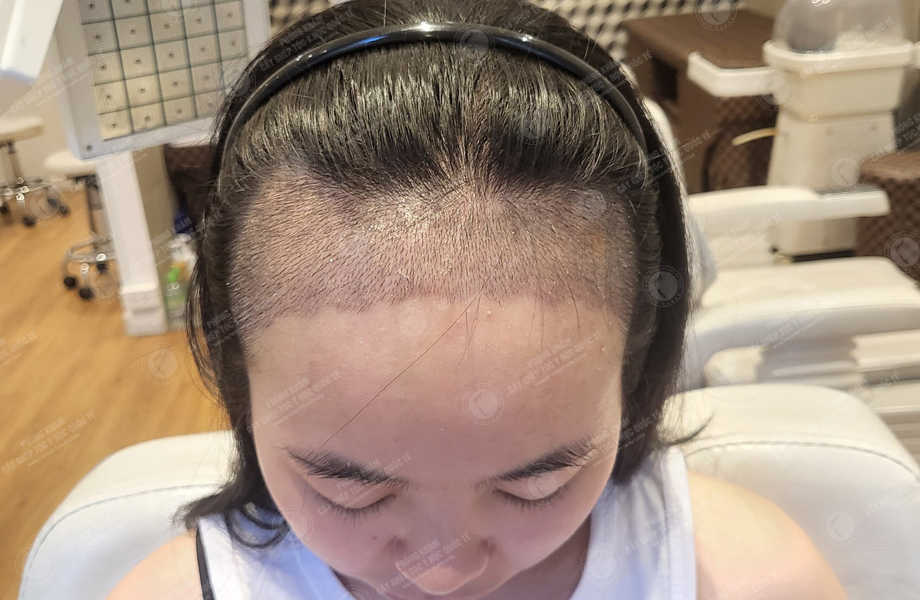 Trần Hoài Phương - Cấy tóc tự thân 10