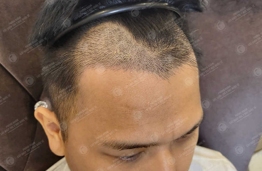 Lý Tuấn Kiệt - Cấy tóc đường chữ M 10