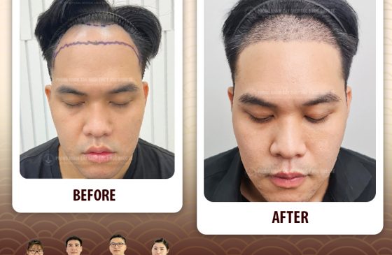 hạ đường chân tóc thu gọn trán giá bao nhiêu
