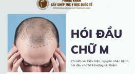Tuyệt chiêu thổi bay tóc hói chữ M không phải ai cũng biết